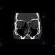 Fracture of orbital floor, teardrop sign, blowout fracture, hemosinus: CT - Computed tomography